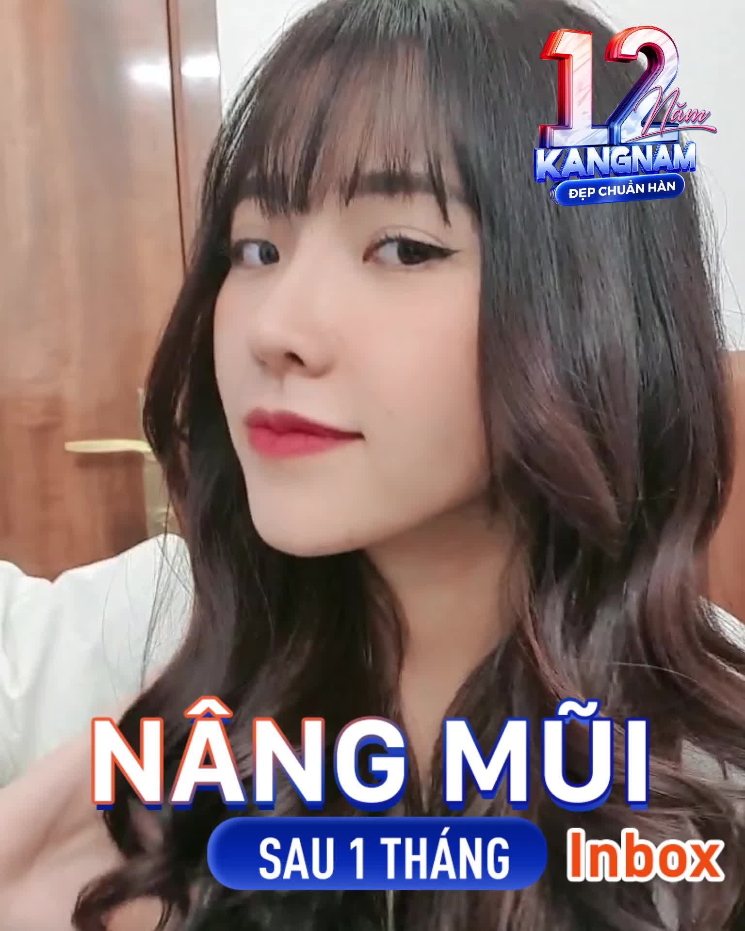 Cực phẩm nâng mũi Kangnam sau 1 tháng
